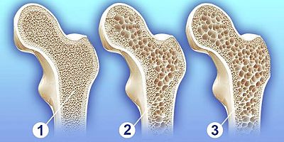 Sessiz ilerleyen hastalık osteoporoz