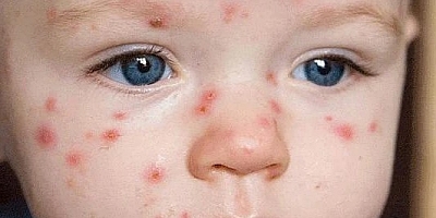 Uzmanı uyardı; Suçiçeği basit görülmemeli!