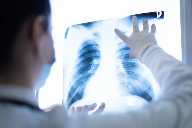 Covid-19 nodülleri akciğer kanseri başlangıcı olabilir”