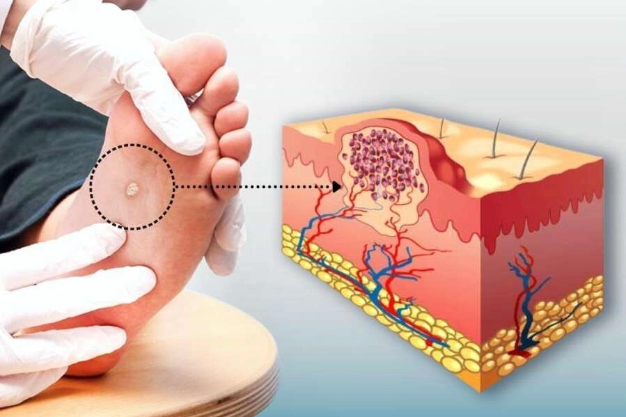 "Yeni mikro dalga tedavisi ile siğillerde mutlu son"